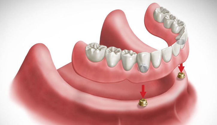 Dentadura moderna - Overdenture (Prótese total ou removível)